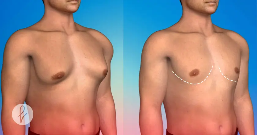 Beneficios de la Corrección de la Ginecomastia Masculina