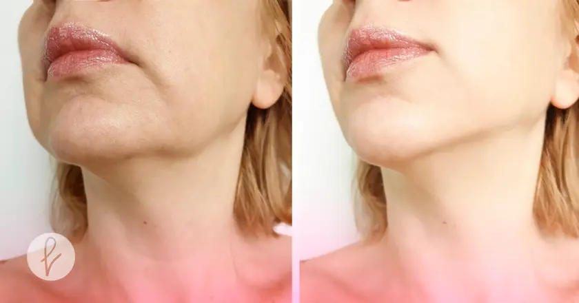 ¿Quiénes son candidatos para una genioplastia?