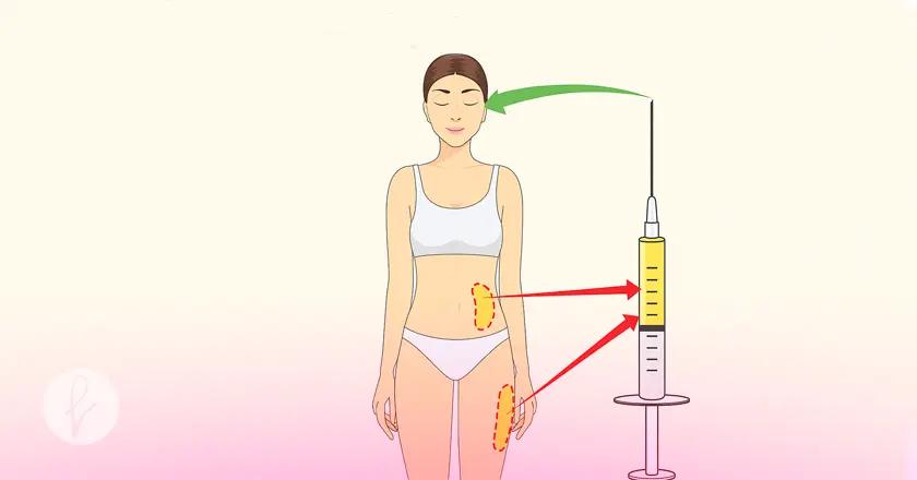 ¿Qué es el lipoinjerto de grasa autóloga?